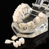 Implante dentaire transparente Maladie Modèle de dents Enseigner des dents Outil Dentaire Adult Typodont Removable Teeth Model