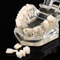 Implante dentaire transparente Maladie Modèle de dents Enseigner des dents Outil Dentaire Adult Typodont Removable Teeth Model